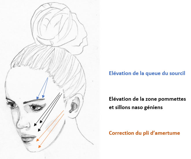 Technique : Les Fils Tenseurs