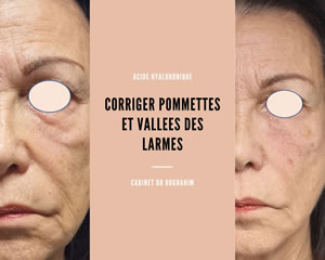 Corriger pommettes et vallée des larmes