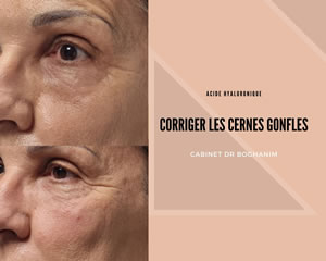 Corriger les cernes gonflés