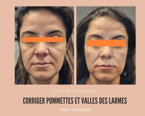 Corriger pommettes et vallée des larmes