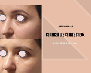 Corriger les cernes creux