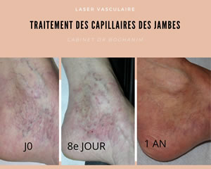 Traitement des capillaires des jambes