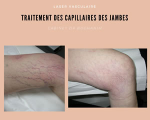 Traitement des capillaires des jambes