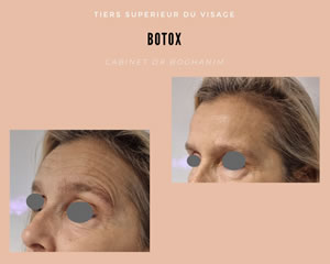 Botox : tiers supérieur du visage