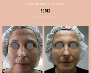 Botox : tiers supérieur du visage