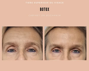 Botox : tiers supérieur du visage