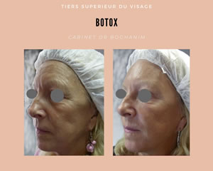 Botox : tiers supérieur du visage