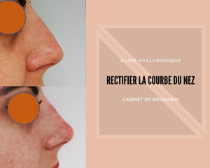 Rectifier la courbe du Nez