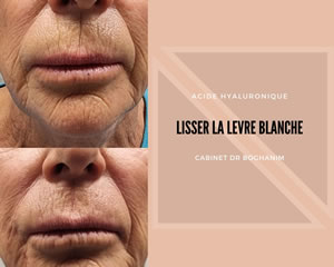 Lisser la lèvre blanche