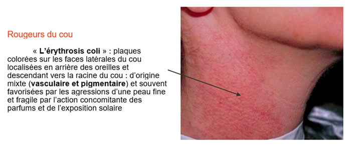 Rougeurs du cou : l'érythrosis coli