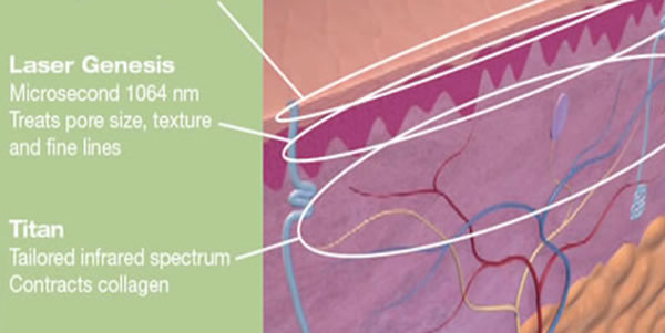 Schema du traitement par le laser Génésis