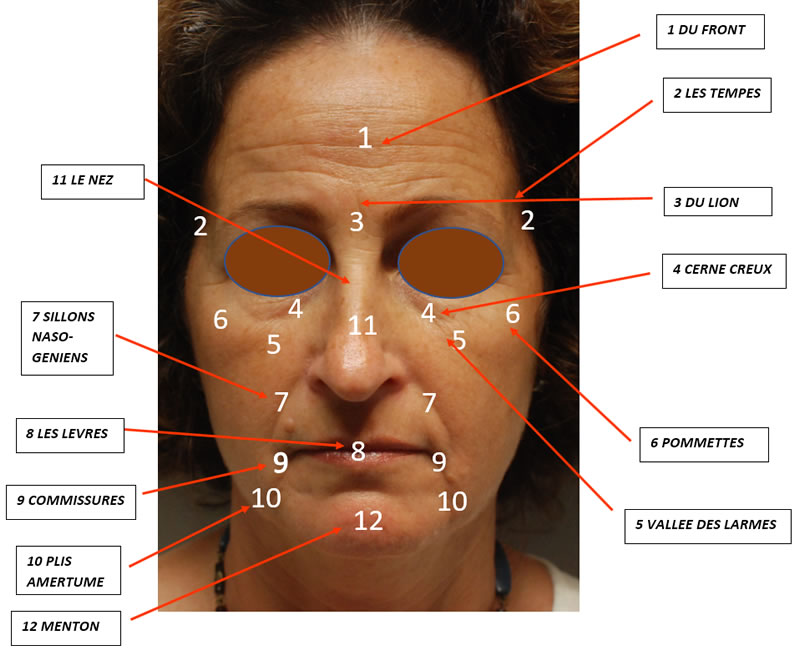Les zones d'injections du visage