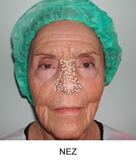 Peeling Profond au Phénol : nez