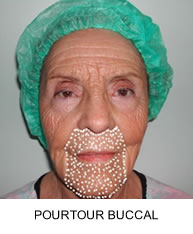 Peeling Profond au Phénol : pourtour buccal