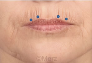 Injections de Botox lèvre supérieure