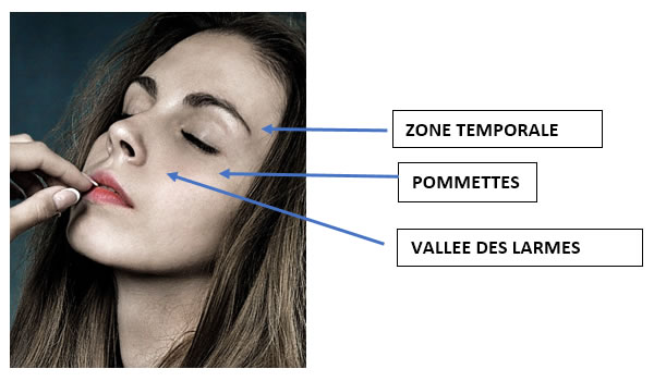 Visage : zone temporale, pommettes et vallée des larmes